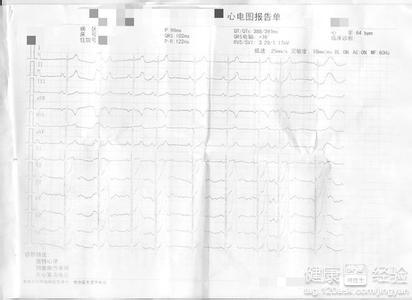 心髒早搏應做哪些檢查