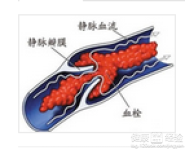 腸系膜靜脈血栓腸壞死能治好嗎