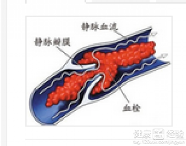 下肢深靜脈血栓是怎麼形成的