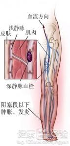 左腿有下肢靜脈血栓要怎樣治療