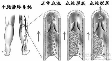 深靜脈血栓小腿肚粗浮腫有紫色有結塊怎麼辦