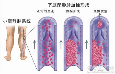 關與靜脈血栓最好的減緩方法是什麼