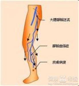 右下肢深靜脈血栓用什麼方法治療安全