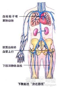 靜脈血栓症如何治療