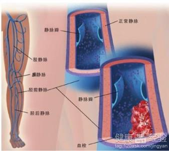 早期動脈硬化的治療方法