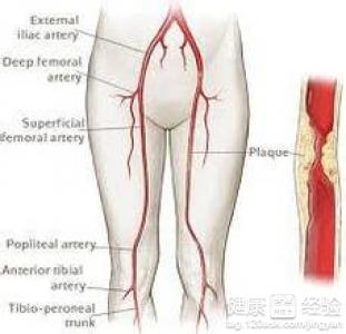 下肢動脈硬化可以泡腳嗎