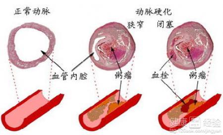 動脈粥樣硬化是什麼