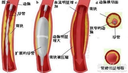 醫學綜述冠狀動脈粥樣硬化性心髒病