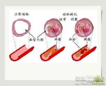 動脈粥樣硬化能治嗎