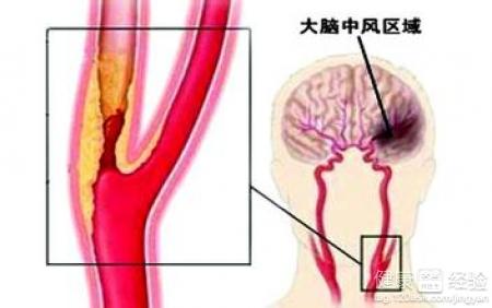 怎麼治療頸動脈硬化