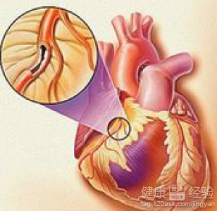 冠狀動脈粥樣硬化的預防措施