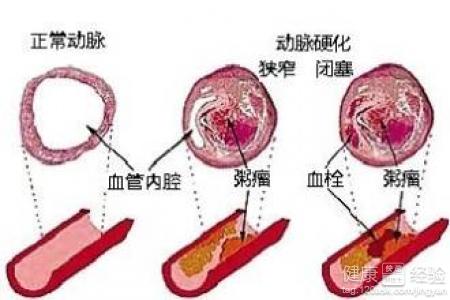 頸總動脈粥樣硬化斑塊