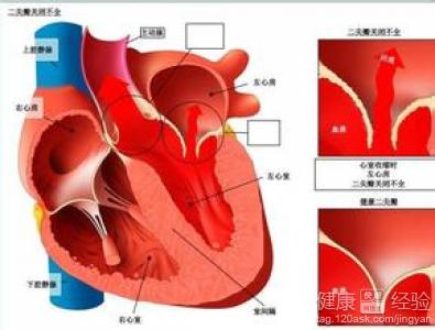 心髒動脈硬化症狀