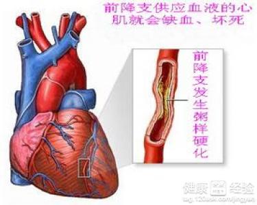 心髒動脈硬化的症狀