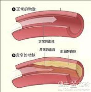 股動脈硬化閉塞症