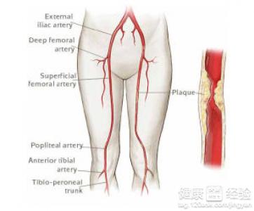 雙下肢動脈硬化閉塞症症狀