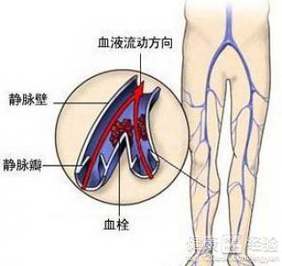 雙腿動脈硬化閉塞症