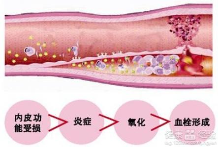 動脈血管硬化的治療