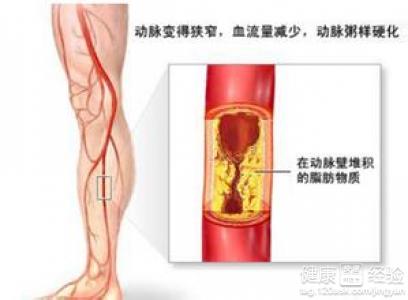 怎樣治動脈硬化