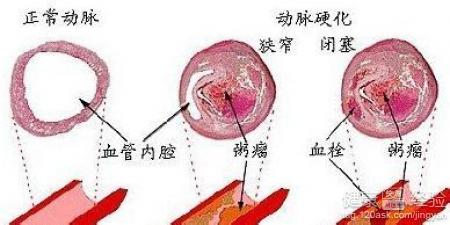 動脈硬化吃什麼食物