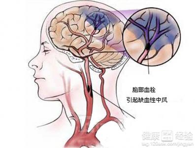 輕度腦動脈硬化症狀