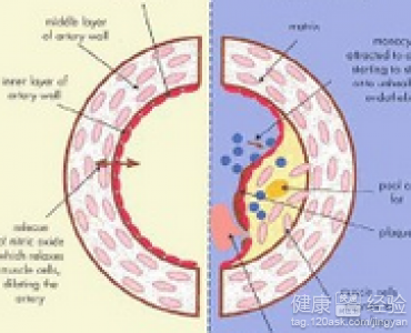 動脈硬化症能治療嗎