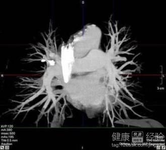 腿部動脈栓塞可否用藥物溶栓