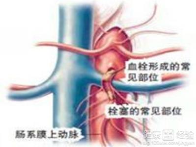 什麼是急性腸系膜上動脈栓塞或血栓形成