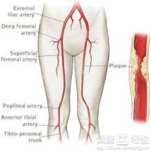 腿部動脈栓塞該怎麼治療