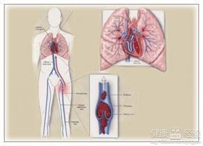 肺動脈栓塞是不是大多情況都一樣