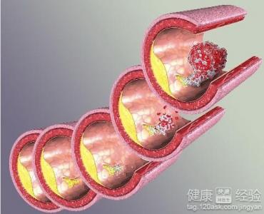 怎麼預防動脈疾病呢？