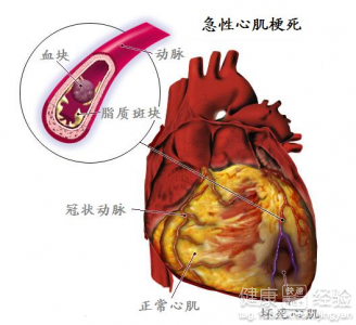 預防心肌梗塞不可忽視哪些健康常識