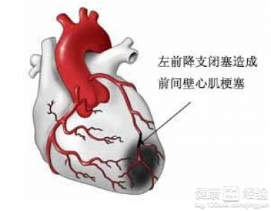 心絞痛、心肌梗塞的急救方法及判斷