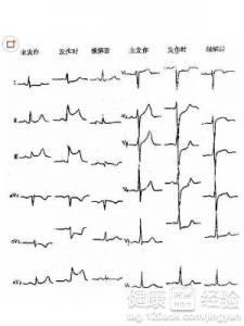 心肌梗死怎樣檢查