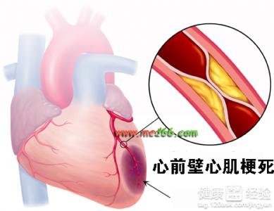 心肌梗塞的前期症狀有哪些