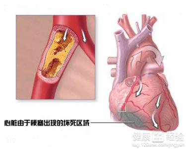 嬰兒心肌梗塞能手術治療嗎