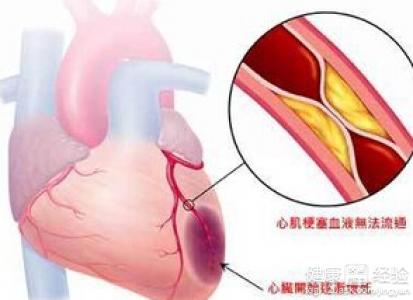 心肌梗塞做手術風險有多大