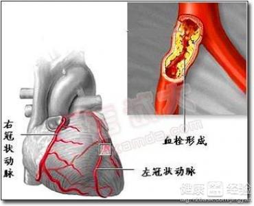 心肌梗塞死搶應急預案是什麼