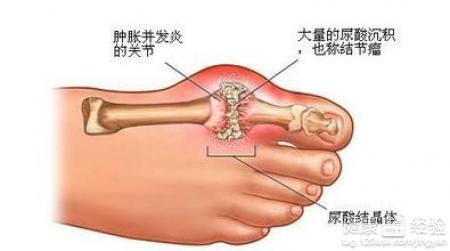 重症痛風伴高血糖怎麼治療啊