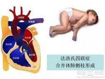 什麼是法樂四聯症?