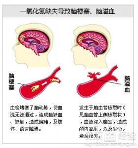 心腦血管病並非老人特有如何預防心腦血管病