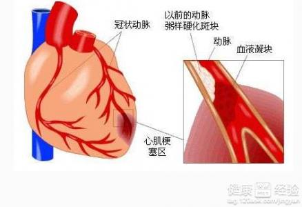 糖尿病性心髒病與冠心病一樣嗎?