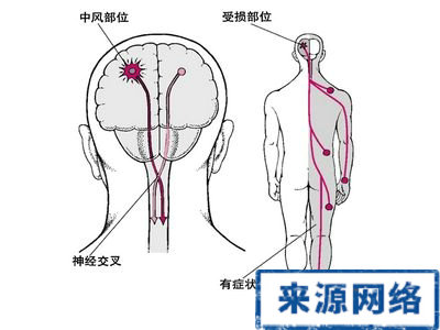 老人中風 防中風 心血管 心髒病 易中風的人群