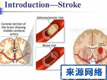 腦中風 腦中風專家與網友問答