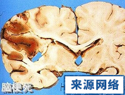 青壯年腦梗死 高血壓 腦出血