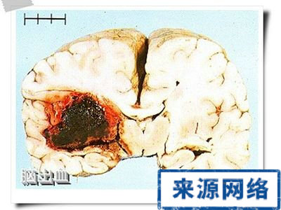 腦出血的類型 腦出血 腦出血種類 腦出血部位