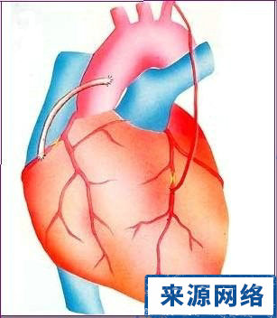 不穩定型心絞痛 心絞痛 心絞痛怎麼辦 心肌梗塞