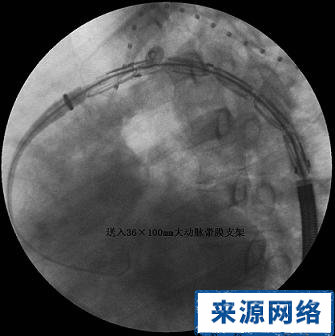 糖尿病 支架 治療 患者 效果