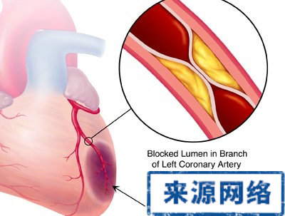 預防心梗 心梗 心肌梗死