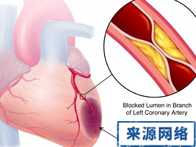 心肌梗死 心肌梗塞 心絞痛 心髒病 心肌梗死護理